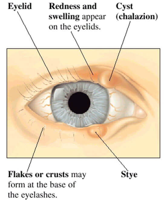 oorzaak en gevolg van cyste in de oog
