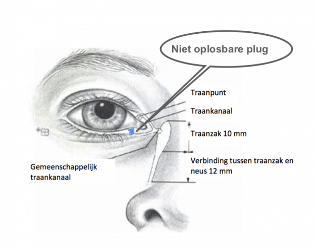 oplossing tranende ogen niet oplosbare ultra plug